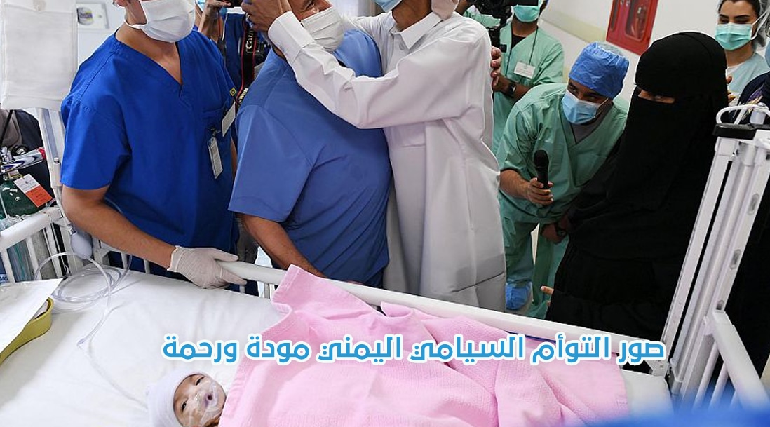صورة معلومات عن  التوأم اليمني مودة ورحمة