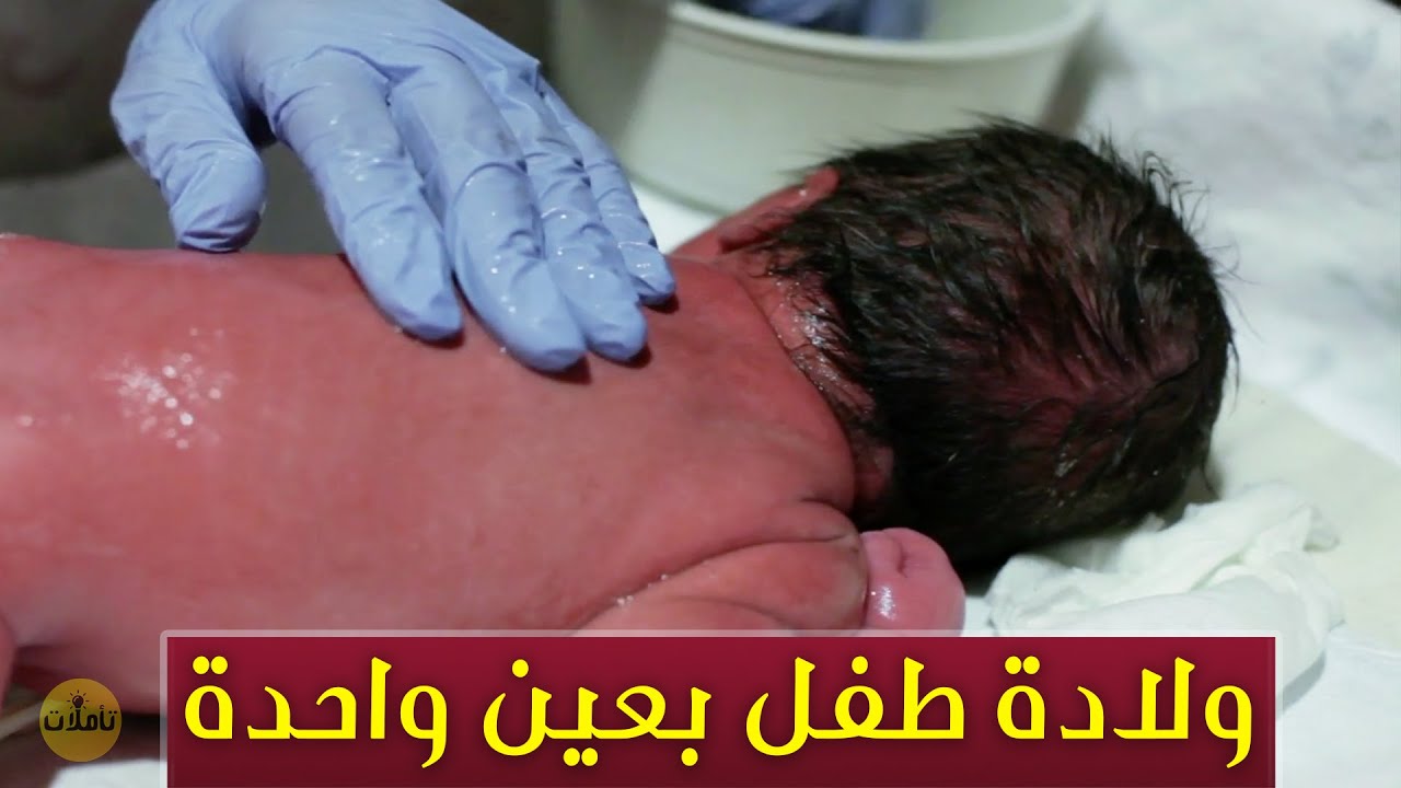 صورة فيديو : اليمن تشهد ولادة طفل بعين واحدة