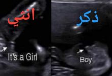 صورة الفرق بين سونار البنت والولد في الشهر الرابع