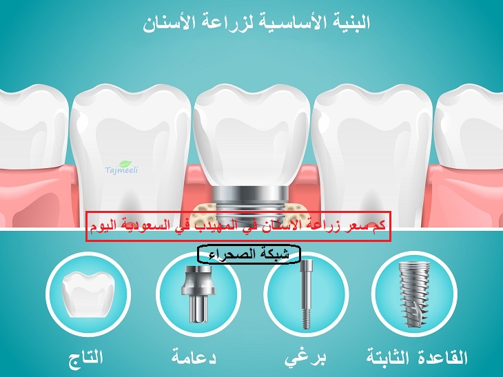 صورة كم اسعار زراعة الاسنان في المهيدب في السعودية