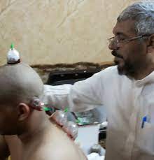 صورة علاج تنسيم الرأس جابر القحطاني بالحجامه والزيوت العطريه