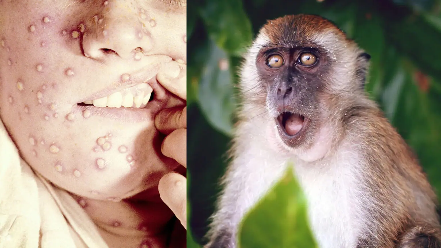 صورة كيف ينتقل جدري القرود بين البشر وما اعراضه